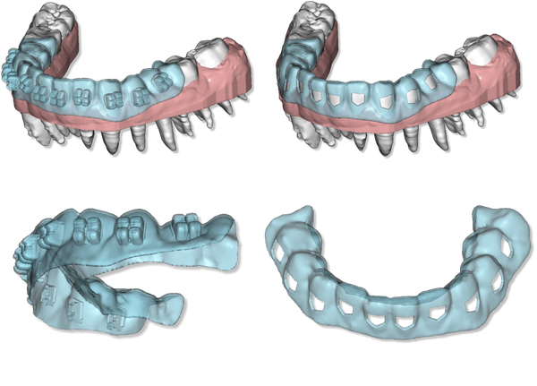 Maestro 3D Ortho Studio Version 4.0 Clear Aligner Module