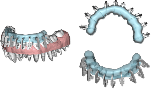 Maestro 3D Ortho Studio Version 4.0 Clear Aligner Module
