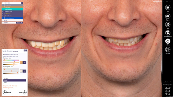 exocad Smile Creator NEW !