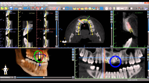 SOFTWARE SETUP FOR PLANNING SURGICAL GUIDE