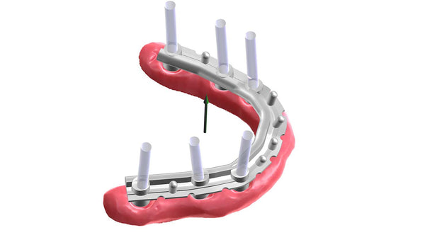 exocad add on module - Bar Module