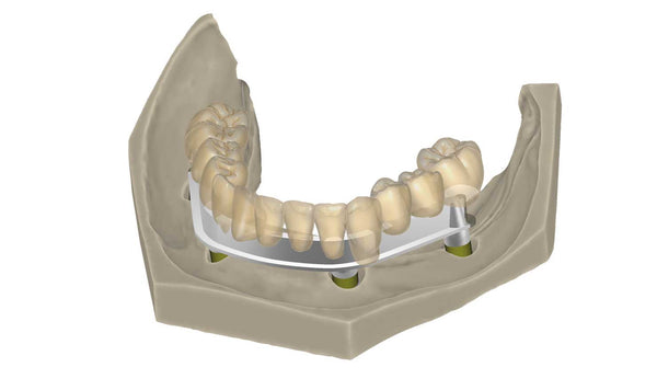 exocad add on module - Bar Module