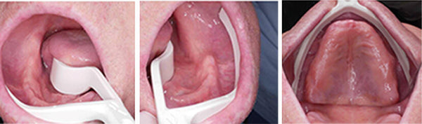 LO RUSSO RETRACTORS - ALL ON X AND EDENTULOUS SCANNING RETRACTORS!