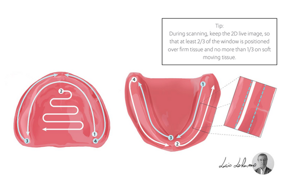 LO RUSSO RETRACTORS - ALL ON X AND EDENTULOUS SCANNING RETRACTORS!