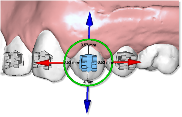 Maestro 3D Ortho Studio Version 4.0 Brackets Placement Module