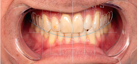 exocad Smile Creator NEW !