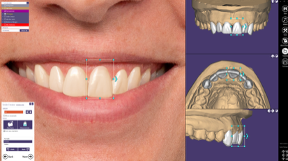 exocad Smile Creator NEW !