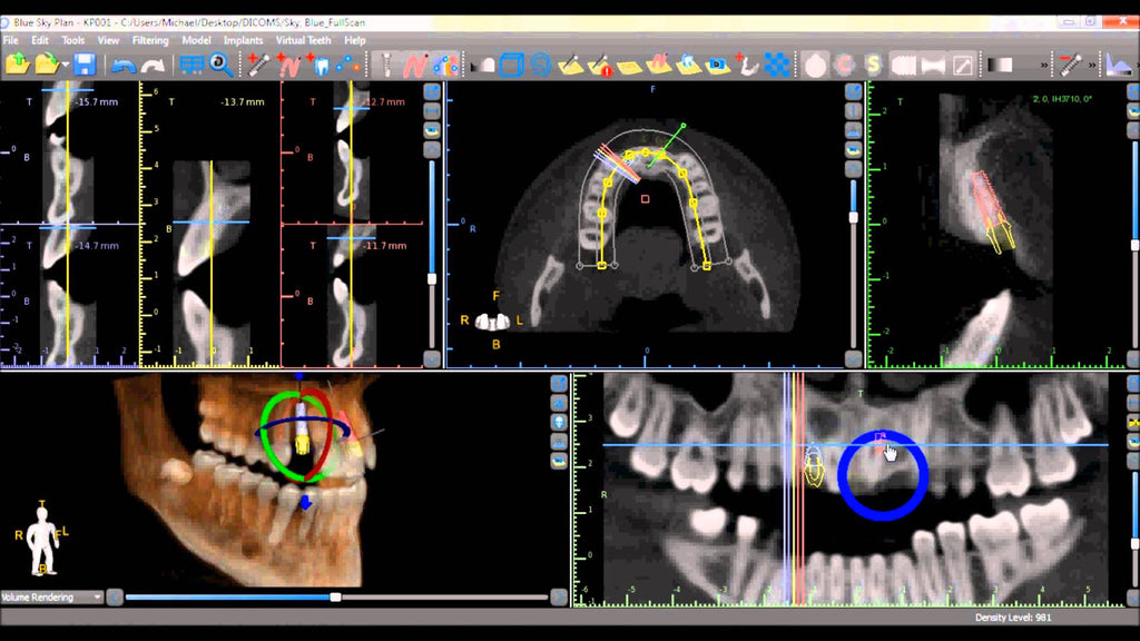 SOFTWARE TRAINING FOR PLANNING SURGICAL GUIDE