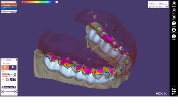 exocad  Bite Spint Module