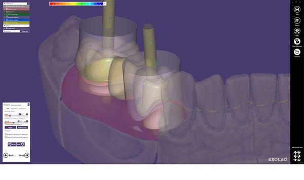 exocad add on module - Implant module