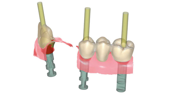 exocad add on module - Implant module