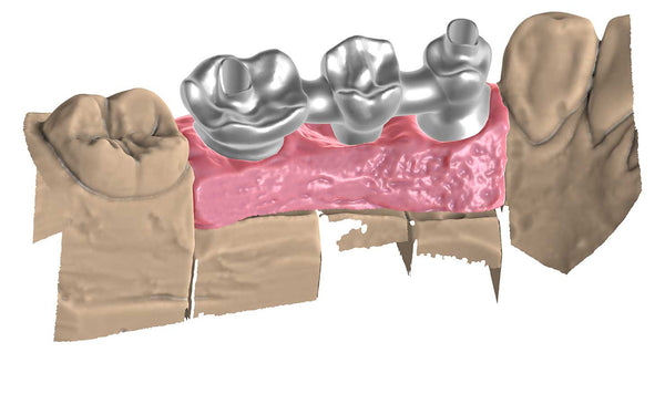 exocad add on module - Implant module