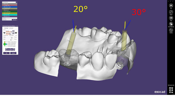 exocad add on module - Implant module