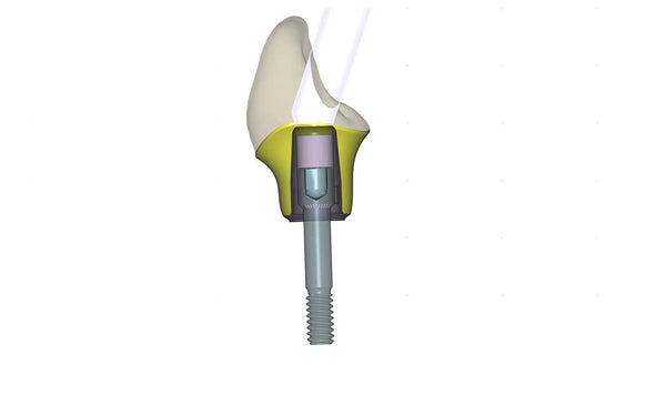 exocad add on module - Implant module