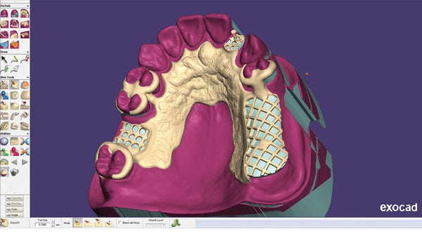 exocad add on module - Removable partial Denture Module  NEW VERSION !