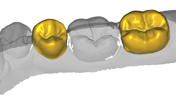 exocad add on module - Provisional Module