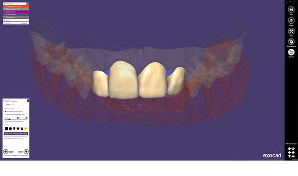 exocad add on module - Provisional Module